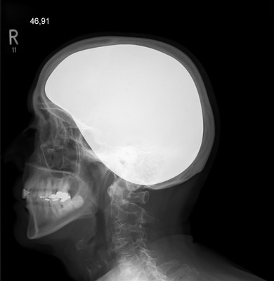 röntgenbild schädel Fotomontage
