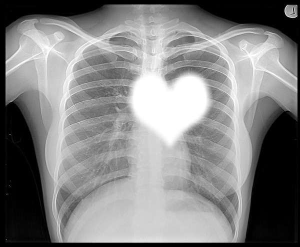 Chest X Ray Fotomontage